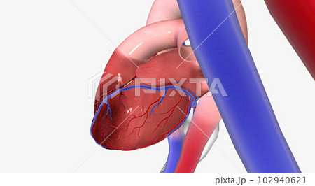 Angina is chest pain or discomfort due to reduced blood flow to the heart. 102940621