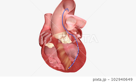 Alcohol causes enlarged heart muscle walls to shrink Alcohol causes enlarged heart muscle walls to shrink 102940649