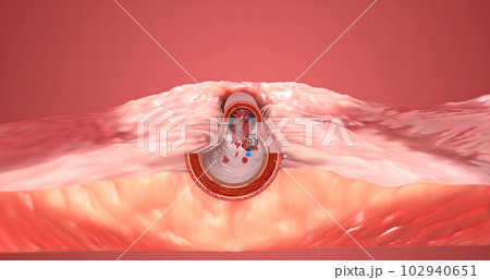 A blood clot is red blood cells that stick together in the bloodstream and are held in place by fibrin. 102940651