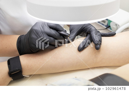 Hirsutism, Closeup Hair Removal Process With Electrolysis On Hand Of White Young Woman, Electric Epilation In Beauty Salon. Horizontal Plane. Authentic Photo 102961478