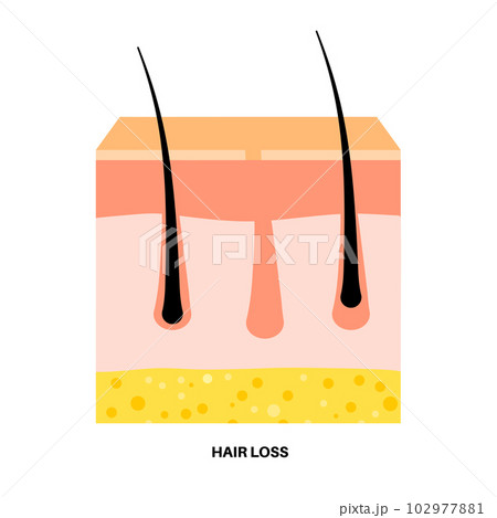 Hair loss pattern 102977881