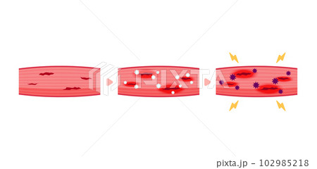 筋肉痛の発生メカニズム・人体の仕組み・ベクターイラスト (文字なし) 筋肉痛の発生メカニズム・人体の仕組み・ベクターイラスト (文字なし) 102985218