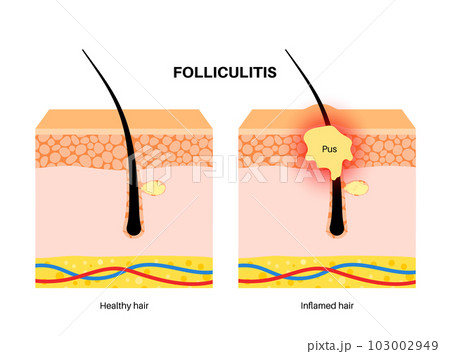 Folliculitis in skin layers 103002949