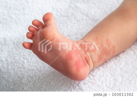 Hemangioma red birthmark on the leg of newborn baby 103011302