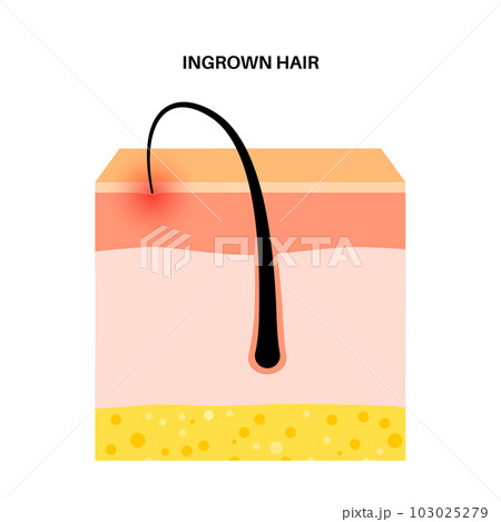 Ingrown hair inflammation Ingrown hair inflammation 103025279