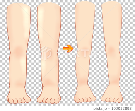 Swelling of the legs 103032898