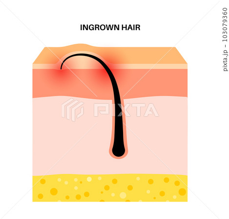 Ingrown hair inflammation 103079360