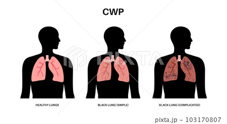 Coal workers disease 103170807