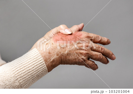 A senior woman is doing a brush massage, experiencing pain. Gray background, hands close-up. The concept of rheumatism and arthritis A senior woman is doing a brush massage, experiencing pain. Gray background, hands close-up. The concept of rheumatism and arthritis 103201004