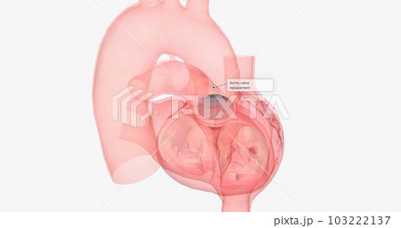 The damaged aortic valve may also be replaced with a mechanical or a biological tissue valve. The damaged aortic valve may also be replaced with a mechanical or a biological tissue valve. 103222137