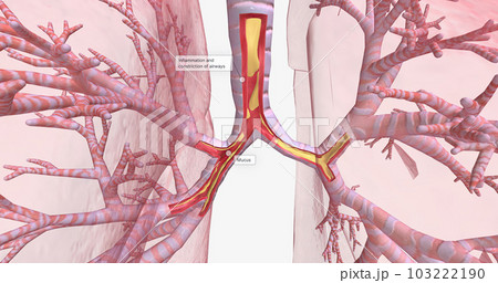 Inflammation and constriction of airways 103222190