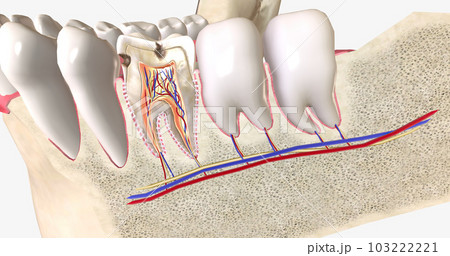 Dental caries, or cavities, are areas of tooth decay caused by acid-producing bacteria in the mouth. Dental caries, or cavities, are areas of tooth decay caused by acid-producing bacteria in the mouth. 103222221