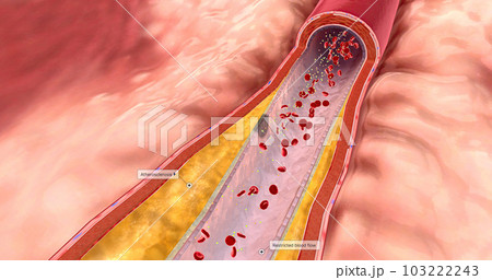 Atherosclerosis can sometimes narrow arteries that blood to the heart is restricted. 103222243