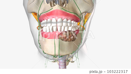 Once a tumor has spread into nearby lymph nodes, it is considered a stage three cancer. 103222317