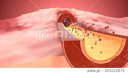Artery dilates due to increase of ARBs in the blood Artery dilates due to increase of ARBs in the blood 103222671
