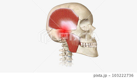 Bruxism is a disorder characterized by abnormal tooth wear due to grinding and clenching of the jaw muscles. 103222736