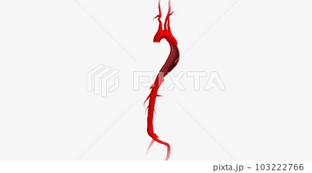 Aortic dissection is a serious cardiovascular condition characterized by a tear in the inner layer of the aorta. Aortic dissection is a serious cardiovascular condition characterized by a tear in the inner layer of the aorta. 103222766