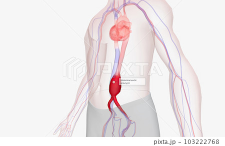 Abdominal aortic aneurysm occurs when the abdominal aorta balloons out due to the weakening of the wall of the artery. Abdominal aortic aneurysm occurs when the abdominal aorta balloons out due to the weakening of the wall of the artery. 103222768