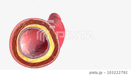 As atherosclerosis progresses, the cholesterol forms a plaque within the wall of the artery. 103222792