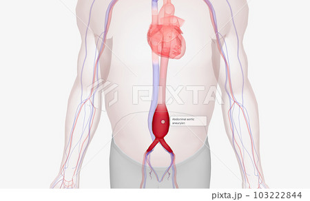 Abdominal aortic aneurysm occurs when the abdominal aorta balloons out due to the weakening of the wall of the artery. 103222844