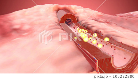 Artery dilates due to increase of ARBs in the blood Artery dilates due to increase of ARBs in the blood 103222880