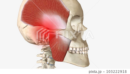Bruxism is a disorder characterized by abnormal tooth wear due to grinding and clenching of the jaw muscles. Bruxism is a disorder characterized by abnormal tooth wear due to grinding and clenching of the jaw muscles. 103222918