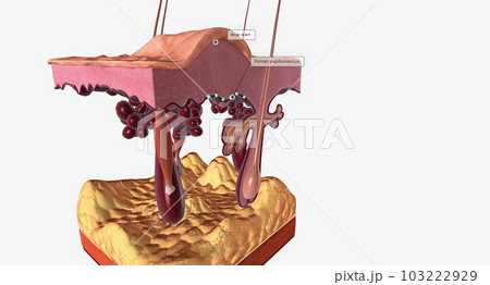 Most anal warts are caused by human papillomavirus (HPV) Most anal warts are caused by human papillomavirus (HPV) 103222929