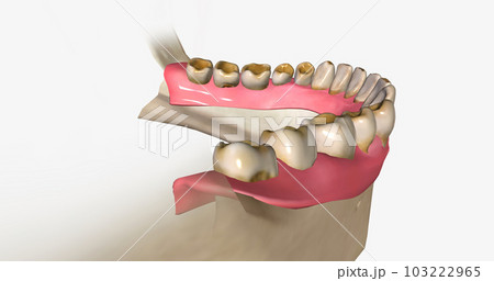 Dental erosion, also known as tooth erosion Dental erosion, also known as tooth erosion 103222965