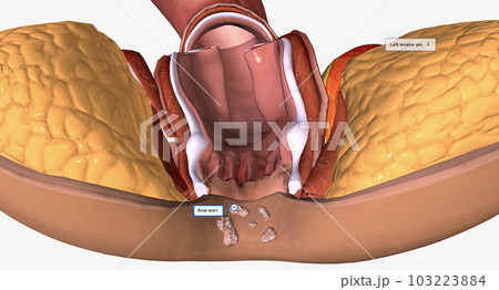 Anal warts are painless, growths along the skin near the anal canal. Most anal warts are caused by human papillomavirus (HPV). Anal warts are painless, growths along the skin near the anal canal. Most anal warts are caused by human papillomavirus (HPV). 103223884