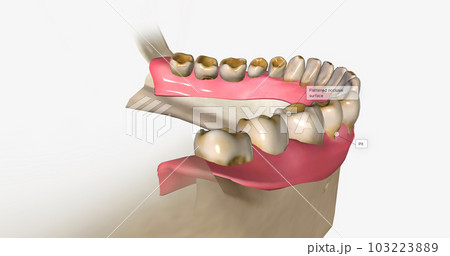 Dental erosion, also known as tooth erosion Dental erosion, also known as tooth erosion 103223889