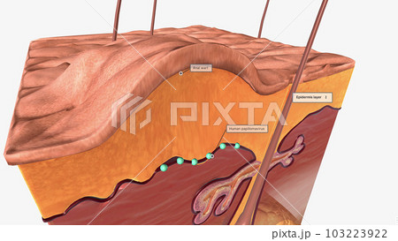 human papillomavirus (HPV). HPV is a common sexually transmitted infection. Certain strains of HPV cause anogenital warts human papillomavirus (HPV). HPV is a common sexually transmitted infection. Certain strains of HPV cause anogenital warts 103223922