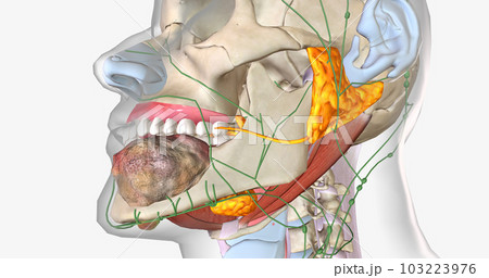 Stage four oral cancer is invasive and has spread beyond the tissue in which it first appeared. 103223976