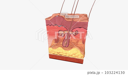Most anal warts are caused by human papillomavirus (HPV) Most anal warts are caused by human papillomavirus (HPV) 103224130