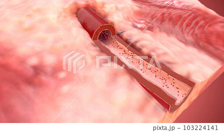 Due to increase of sodium and aldosterone in the blood artery constrict 103224141