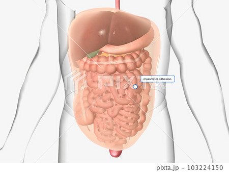 Abdominal adhesions, also called small intestine or GI adhesions Abdominal adhesions, also called small intestine or GI adhesions 103224150