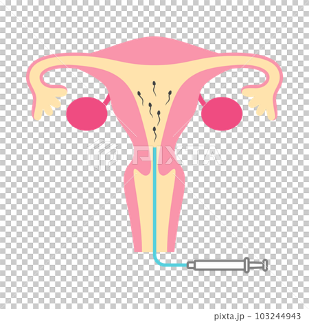 Illustration of artificial insemination Illustration of artificial insemination 103244943