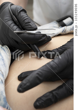 Cropped Dermatologist Removes Hair On Woman's Belly, Abdomen With Electrolysis Procedure, Electric Epilation In Beauty Salon. Vertical Plane. Authentic High quality photo. Cropped Dermatologist Removes Hair On Woman's Belly, Abdomen With Electrolysis Procedure, Electric Epilation In Beauty Salon. Vertical Plane. Authentic High quality photo. 103249696