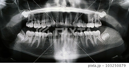 Panoramic X-ray of the jaw. X-ray of the teeth of a 12-year-old girl Panoramic X-ray of the jaw. X-ray of the teeth of a 12-year-old girl 103250879