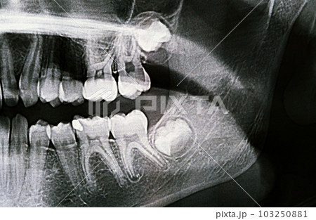 Panoramic X-ray of the jaw. X-ray of the teeth of a 12-year-old girl 103250881