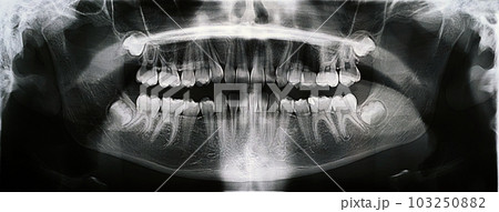 Panoramic X-ray of the jaw. X-ray of the teeth of a 12-year-old girl 103250882