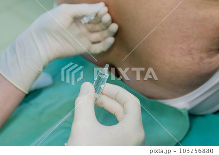 During procedure patient is positioned in sterile surgical room, typically on sitting up to allow access to lumbar region. During procedure patient is positioned in sterile surgical room, typically on sitting up to allow access to lumbar region. 103256880