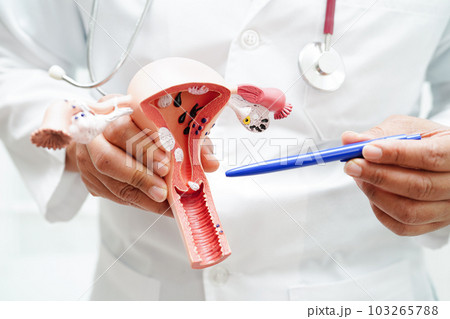 Uterus, doctor holding anatomy model for study diagnosis and treatment in hospital. 103265788