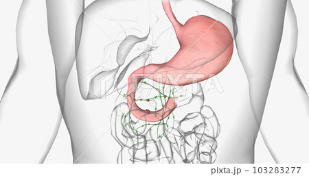 Stage III adenocarcinoma in duodenum 103283277
