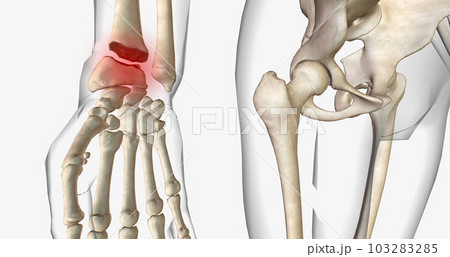 Distal radius fractures are among the most common types of fractures and are most common in the upper extremities. Distal radius fractures are among the most common types of fractures and are most common in the upper extremities. 103283285