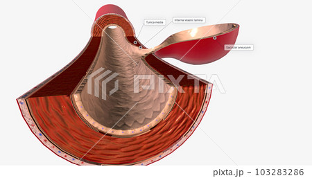The majority of brain aneurysms are saccular aneurysms that are round and expand from one side of the vessel. The majority of brain aneurysms are saccular aneurysms that are round and expand from one side of the vessel. 103283286
