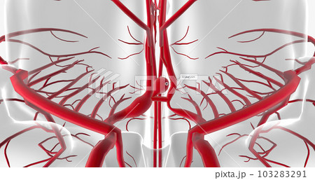An aneurysm is the ballooning expansion of a blood vessel due to weakened structure or damage to the vessel wall. 103283291