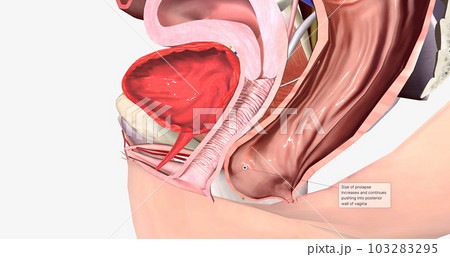 Grade 2 describes a rectocele in which the bulge reaches the level of the hymen, or vaginal opening, without passing it. 103283295