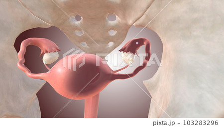 Embryo Implantation in Fallopian Tube 103283296