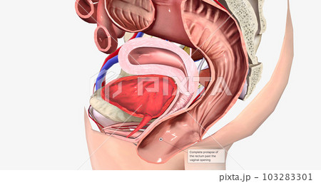 Complete prolapse of the rectum past the vaginal opening 103283301