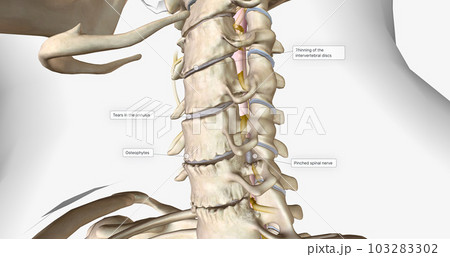 Cervical disc degeneration, or cervical disc disease, is a process that occurs naturally with age. 103283302
